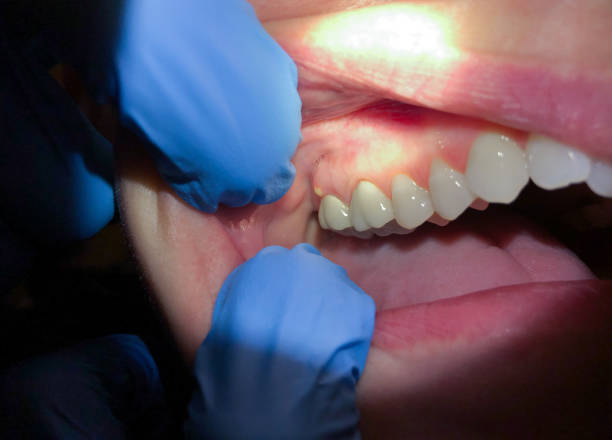 Best Emergency Treatment for Toothache in Westlake, TX